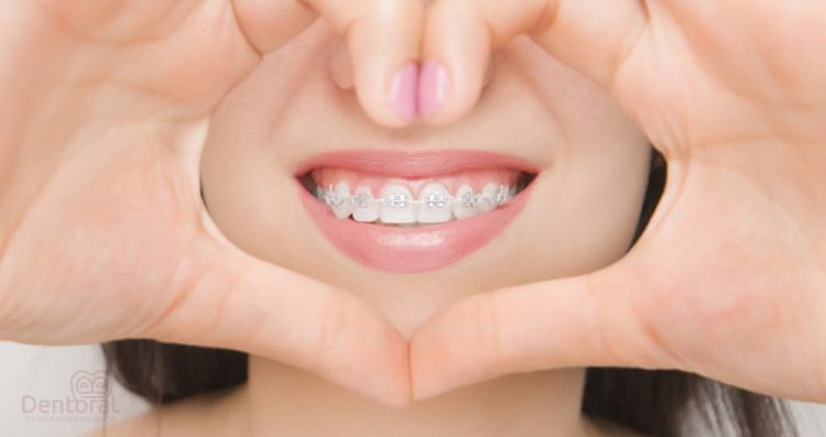 Ideas Para Realizar Una Buena Higiene Dental Con Ortodoncia