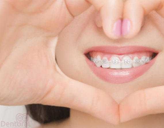 Ideas para realizar una buena higiene dental con ortodoncia