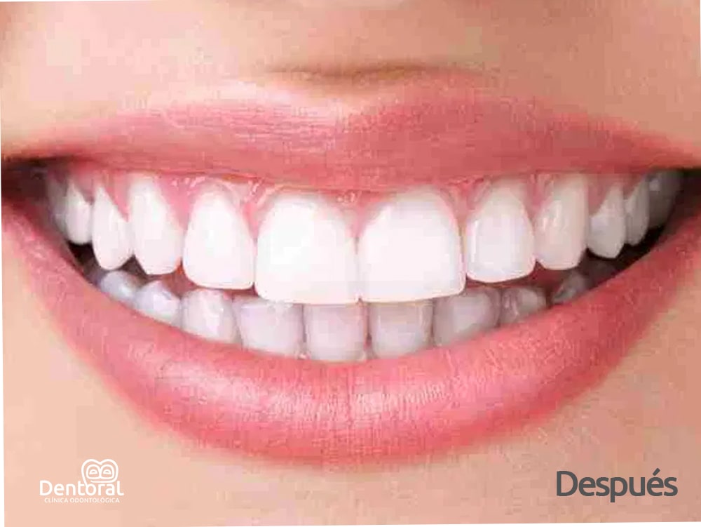 Blanqueamiento Dental Despues - dentoral